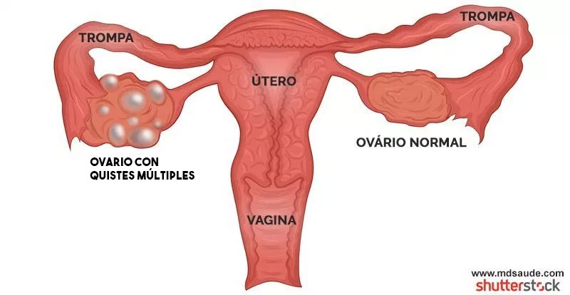 Ovario poliquístico  