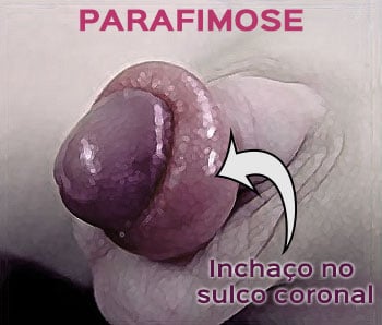 Parafimose
