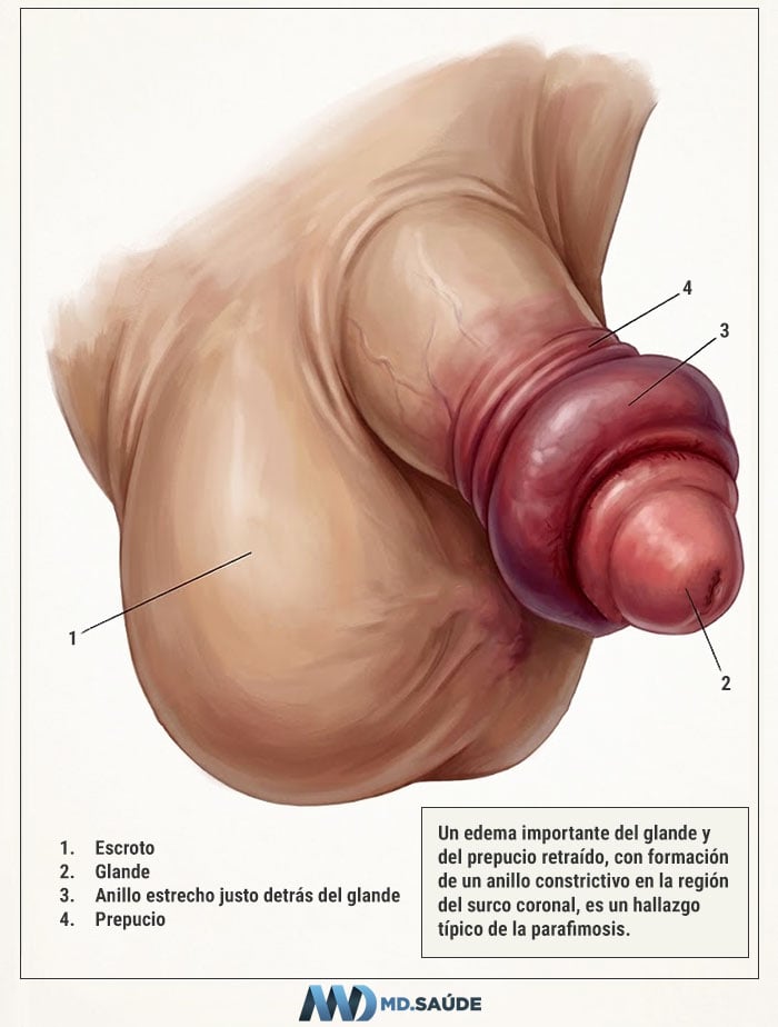Parafimosis: el prepucio retraído queda atrapado detrás del glande y forma un anillo constrictivo, provocando un edema progresivo. Es una urgencia médica y debe tratarse rápidamente.
