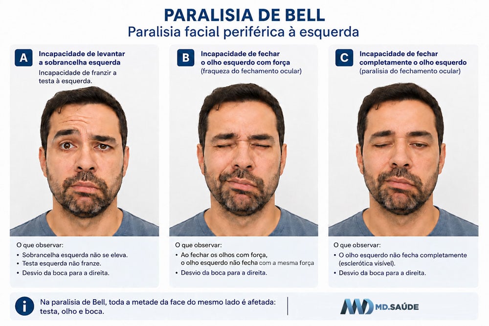 Sintomas da paralisia de Bell