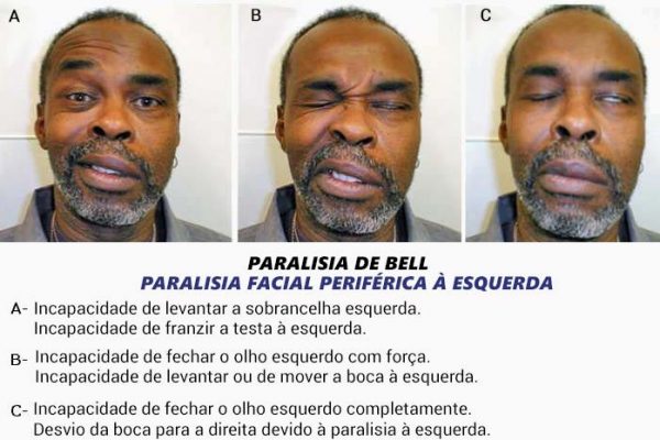 Paralisia de Bell | O que é, causas, sintomas e tratamento