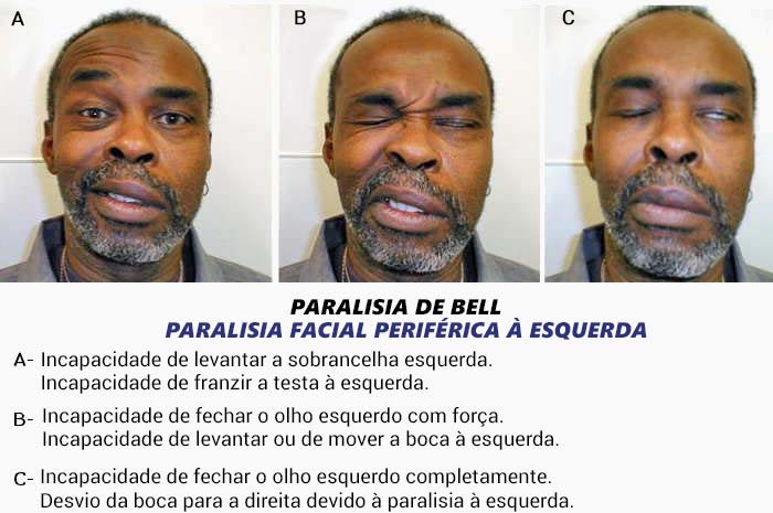 Sintomas da paralisia de Bell