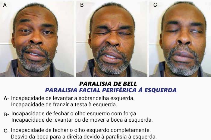 Paralisia Facial 19