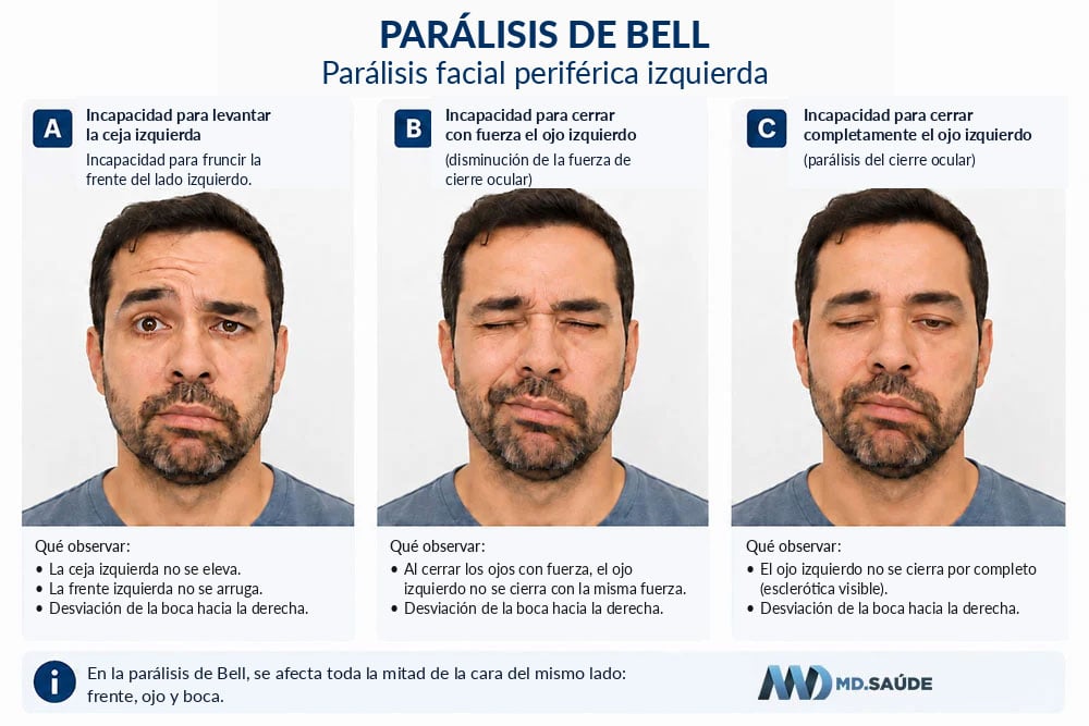 Síntomas de la parálisis de Bell: incapacidad para levantar la ceja y cerrar el ojo izquierdo