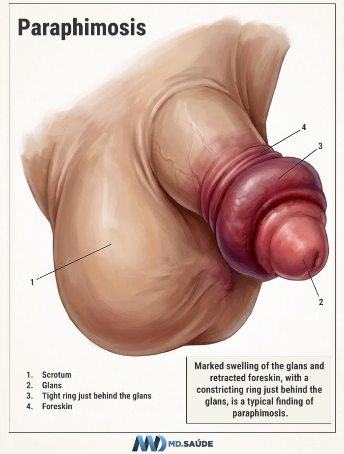 Paraphimosis: the retracted foreskin becomes trapped behind the glans and forms a constricting ring, causing progressive swelling. It is a medical emergency and must be treated promptly.