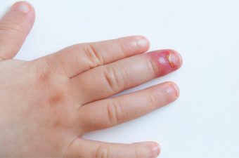 UNHA INFLAMADA (paroníquia) – Causas e tratamento