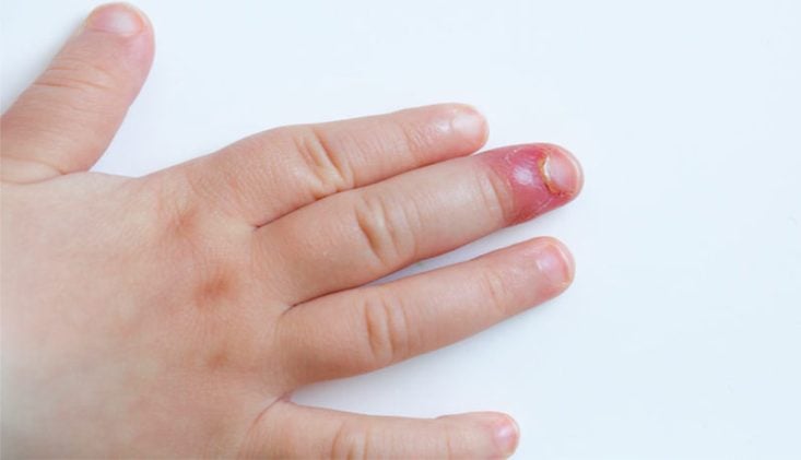 Paronychia (nail fold infection)