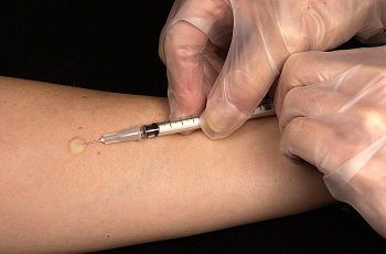 PPD-Mantoux
