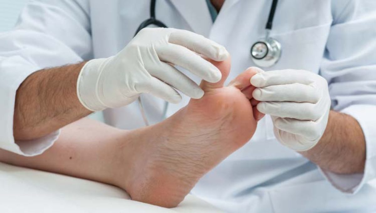 mensaje riñones pollo pie de atleta hongo tratamiento Subir y bajar