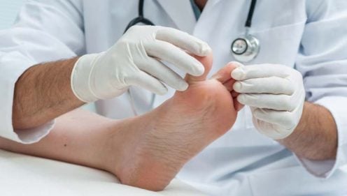 Hongos en los pies (pie de atleta): qué es y tratamiento