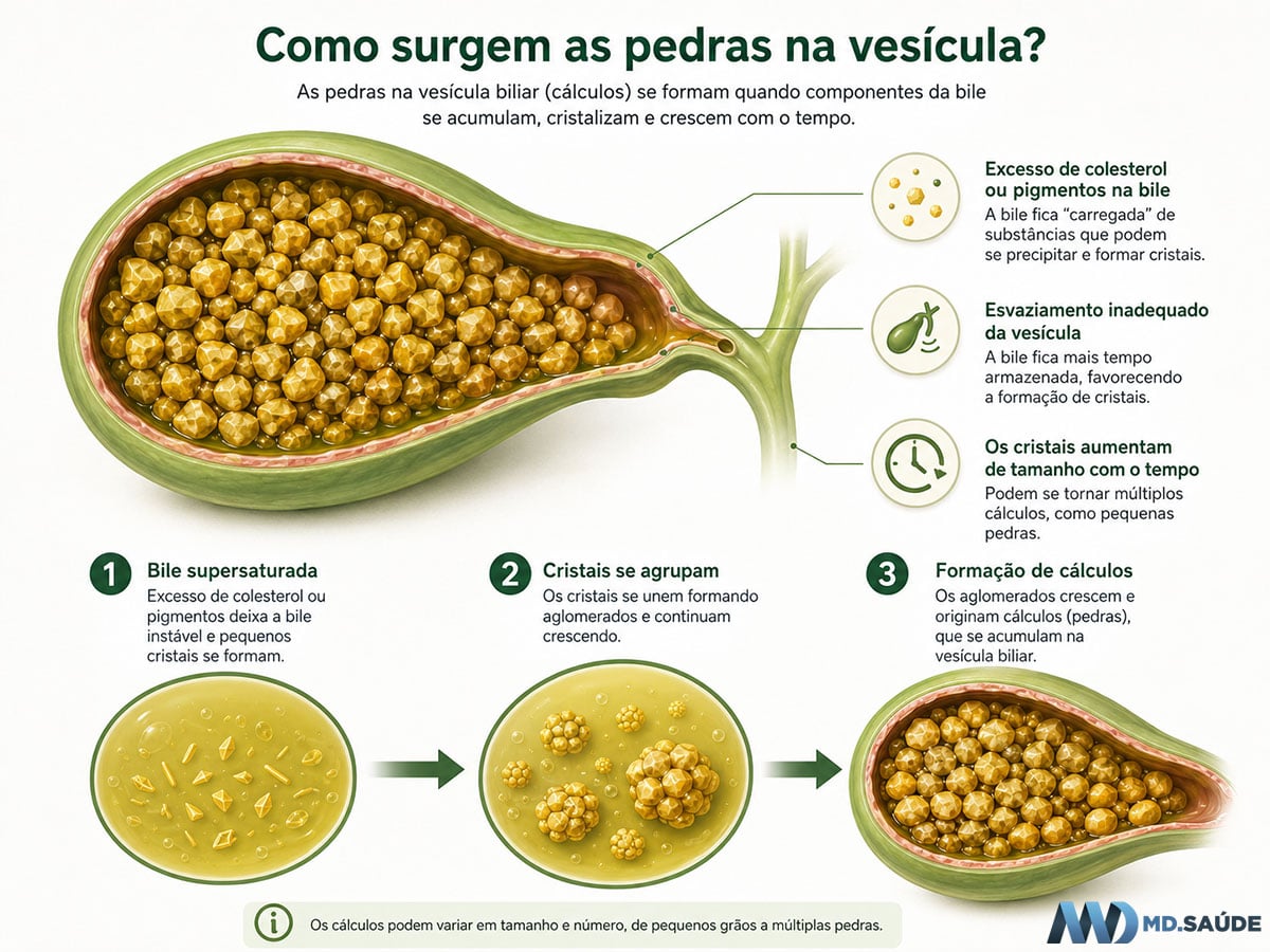 Como surgem as pedras na vesícula?