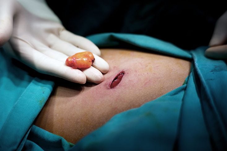 Lipoma pequeño extirpado quirúrgicamente