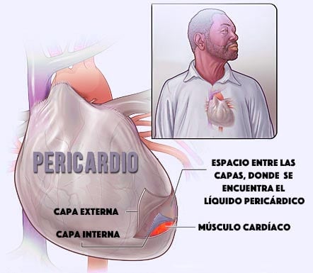 pericardio - pericarditis