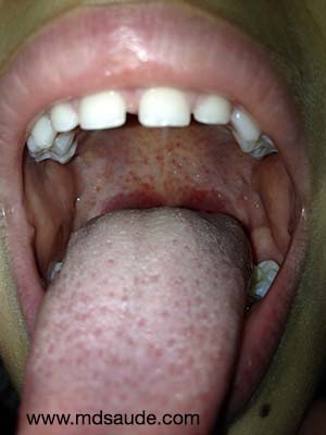 Petéquias no palato - provável faringite bacteriana