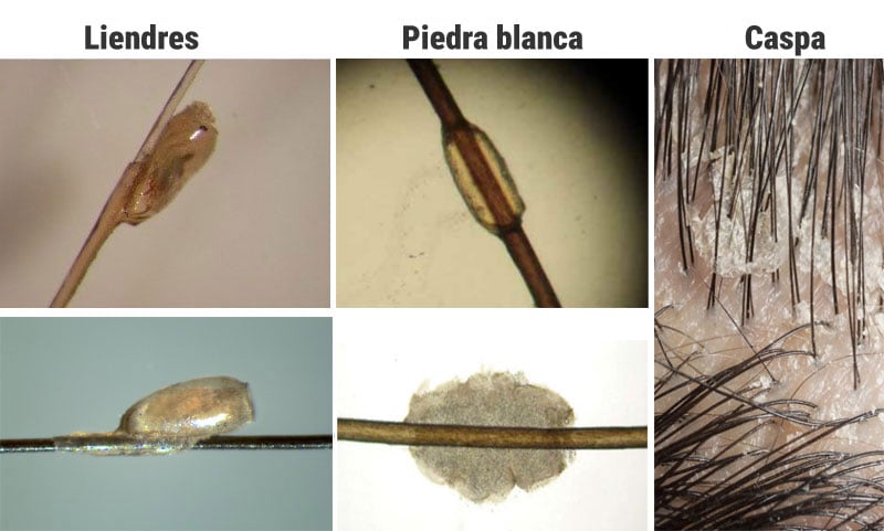 Diferencias entre liendres, piedra blanca y caspa
