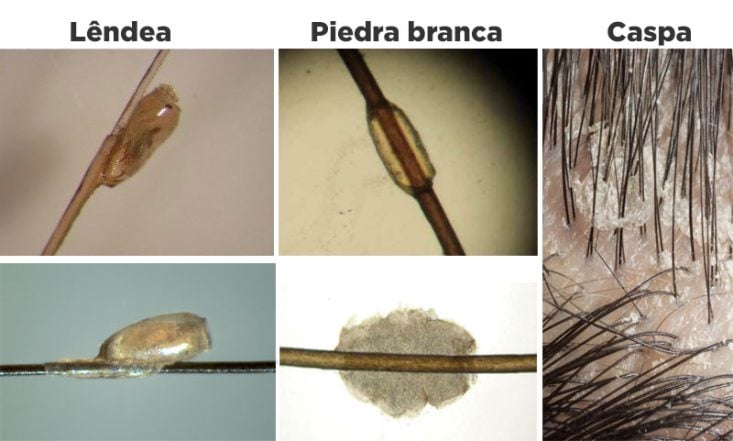 Diferenças entre lêndeas, piedra branca e caspa