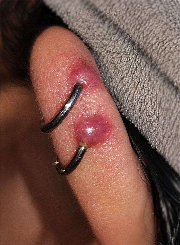 Inflammatory bumps around piercings in the ear cartilage. Trauma, pressure, or repeated movement of the jewelry can cause redness, swelling, and small “bumps” during the healing process without necessarily indicating an infection.