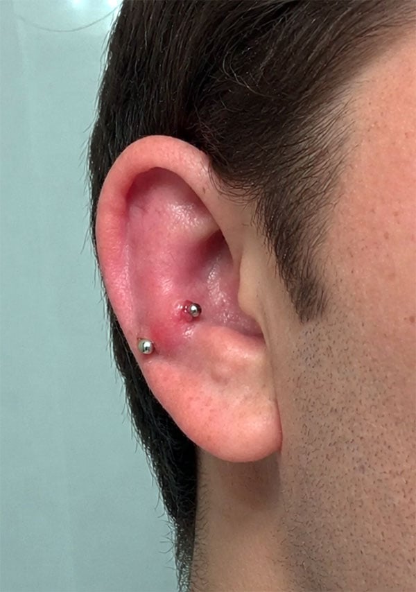 Inflammation of the ear cartilage after a piercing. Redness, pain, and swelling of the cartilaginous part of the ear may indicate perichondritis, an infectious complication that requires medical evaluation and may require antibiotic treatment.