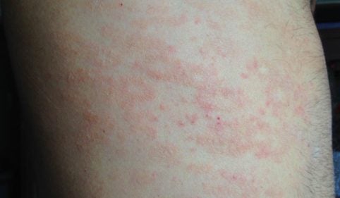 Pitiriasis rosada de Gibert: síntomas, causas y tratamiento
