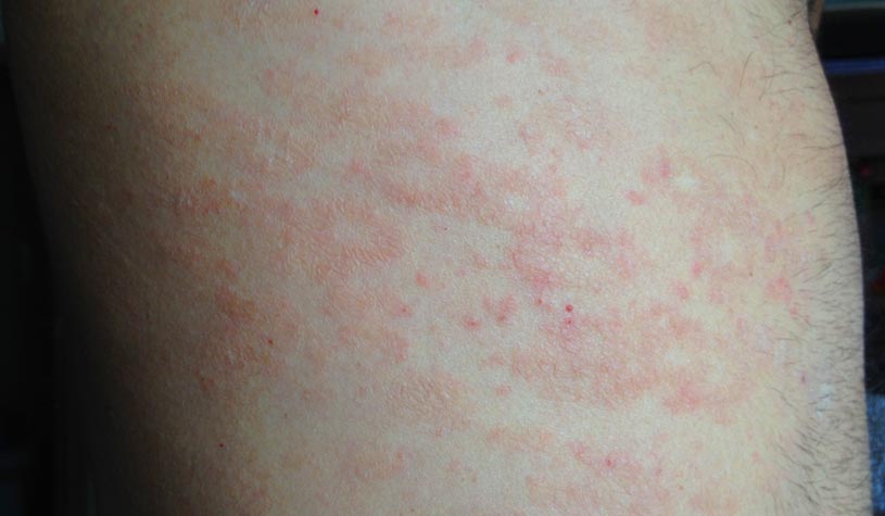 Pitiriasis rosada de Gibert: síntomas, causas y tratamiento