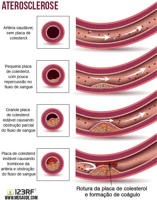 Infarto: 5 sintomas que devem ser notados para evitar complicações