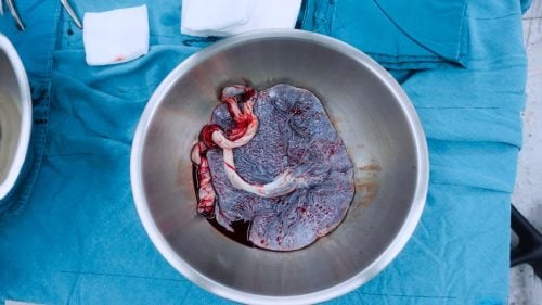 Desprendimiento de placenta: qué es, causas y tratamiento