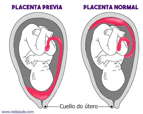 Placenta Previa Causas Sintomas Y Tratamiento Md Saude