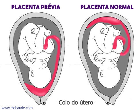 Placenta prévia