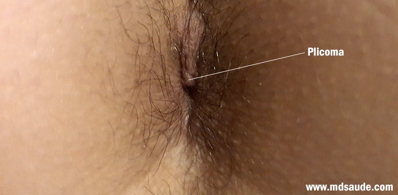 Plicoma anal