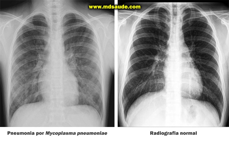 Infiltrados intersticiais em paciente com pneumonia atípica por Mycoplasma pneumoniae.