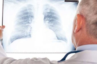 NEUMONÍA – Síntomas, causas y tratamiento