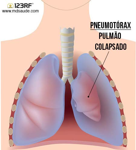Pneumotórax