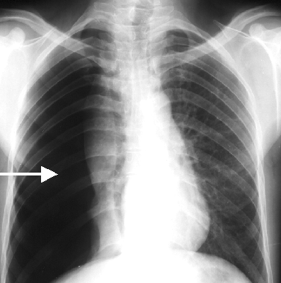 Neumotórax en la radiografía
