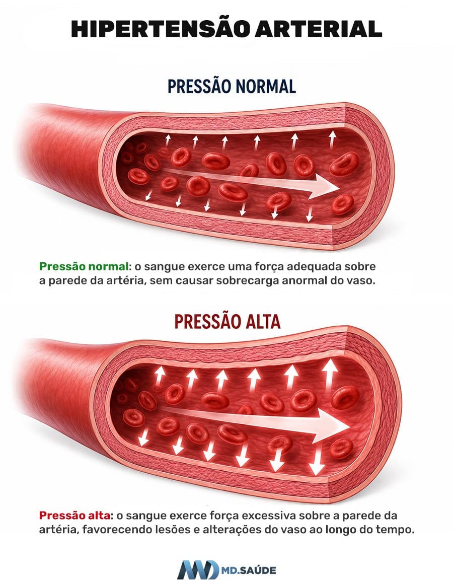 Hipertensão arterial