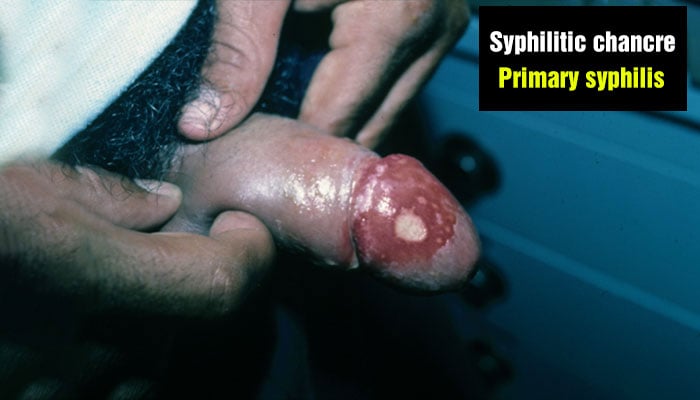  Syphilitic chancre on the penis