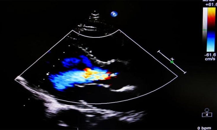 Prolapso mitral