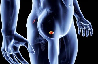 El varicocele da impotencia