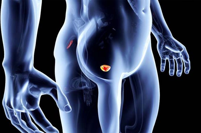 prostatite e tumore al colon al