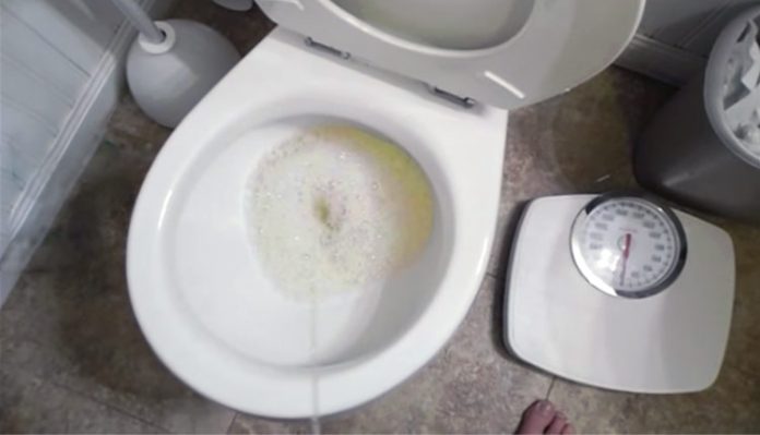 proteinuria-imagem Proteinúria - urina espumosa