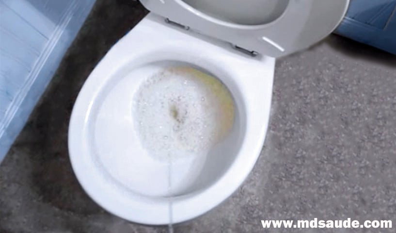 Espuma na urina provocada por proteinúria