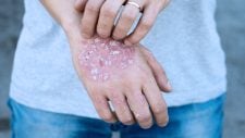 Psoriasis