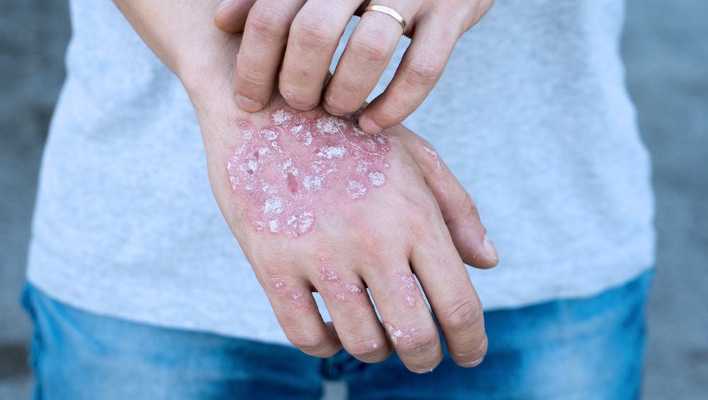 plakkos psoriasis fotók s kezels