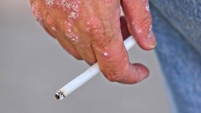 psoriase-ilustracao Psoríase