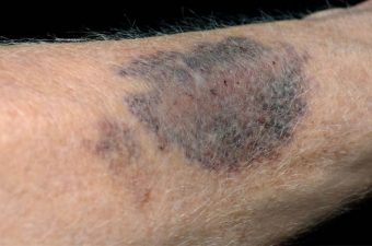 Púrpura trombocitopênica idiopática (PTI) – O que é, sintomas e tratamento