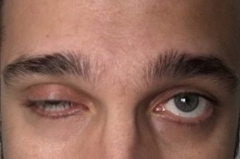 MIASTENIA GRAVIS – Causas, Síntomas y Tratamiento