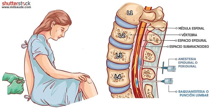 Cómo surge la cefalea espinal (cefalea por hipotensión)