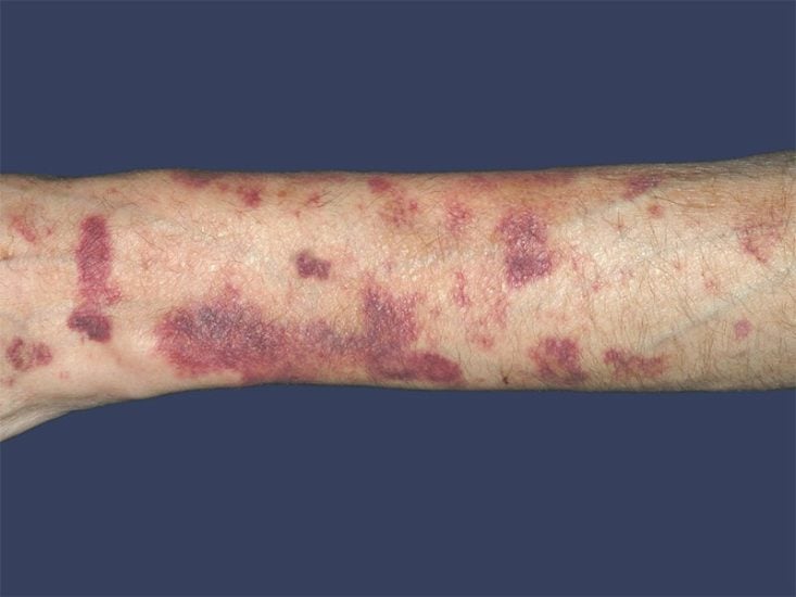 Equimosis inducida por corticosteroides