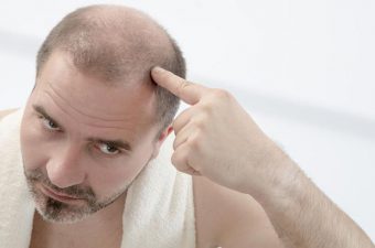 ALOPECIA (caída de cabello) – Causas y tratamiento