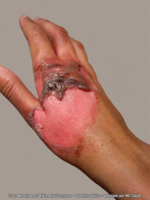Quemadura profunda de segundo grado en el dorso de la mano, causada por agua hirviendo.
