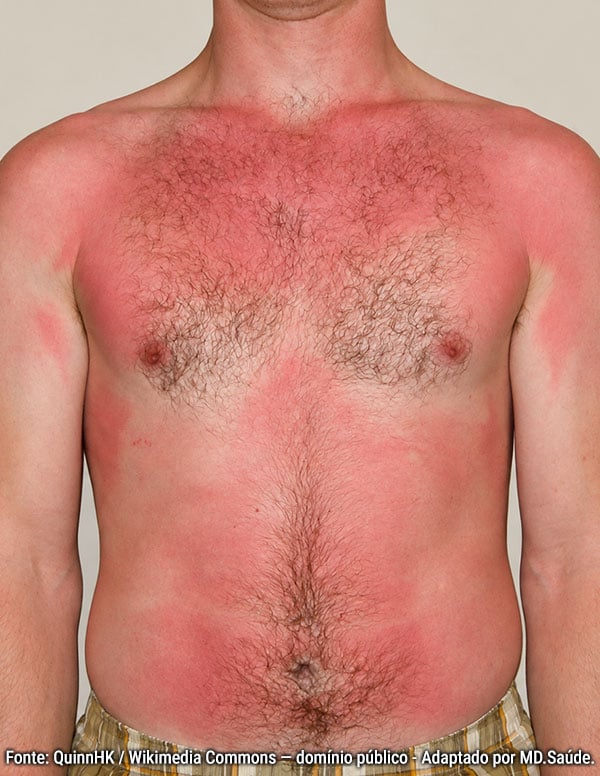 Hombre con quemadura solar de primer grado en el tórax y el abdomen, con enrojecimiento difuso de la piel y sin ampollas.